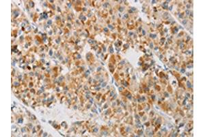 The image on the left is immunohistochemistry of paraffin-embedded Human liver cancer tissue using ABIN7130419(NGB Antibody) at dilution 1/20, on the right is treated with fusion protein. (Neuroglobin 抗体)
