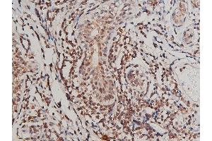 ABIN6267415 at 1/200 staining human breast cancer tissue sections by IHC-P. (FLT1 抗体  (pTyr1213))