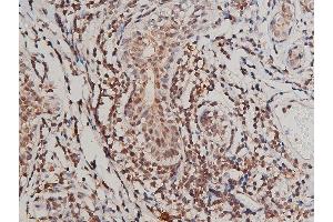 ABIN6267415 at 1/200 staining human breast cancer tissue sections by IHC-P.