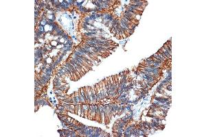 Immunohistochemistry of paraffin-embedded human colon carcinoma using GP Rabbit mAb (ABIN1682863, ABIN3017875, ABIN3017876 and ABIN7101532) at dilution of 1:100 (40x lens). (GPA33 抗体)