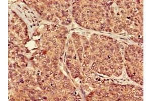 Immunohistochemistry of paraffin-embedded human ovarian cancer using ABIN7164854 at dilution of 1:100 (PTGER3 抗体  (AA 1-49))