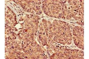 Immunohistochemistry of paraffin-embedded human ovarian cancer using ABIN7164854 at dilution of 1:100