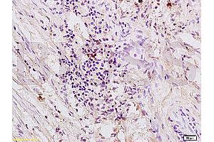 Formalin-fixed and paraffin embedded human colon carcinoma labeled with Anti-PAR-1 Polyclonal Antibody (ABIN728743), Unconjugated at 1:200, followed by conjugation to the secondary antibody and DAB staining