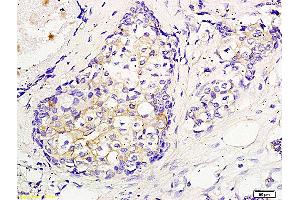 Formalin-fixed and paraffin embedded human breast cancer labeled with Anti CEP55 Polyclonal Antibody, Unconjugated (ABIN872963) followed by conjugation to the secondary antibody and DAB staining (CEP55 抗体  (AA 151-250))
