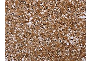 The image on the left is immunohistochemistry of paraffin-embedded Human prostate cancer tissue using ABIN7191451(MFF Antibody) at dilution 1/25, on the right is treated with synthetic peptide. (MFF 抗体)