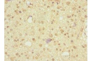 Immunohistochemistry of paraffin-embedded human glioma using ABIN7161221 at dilution of 1:100 (Neurexin 3 抗体  (AA 1584-1643))