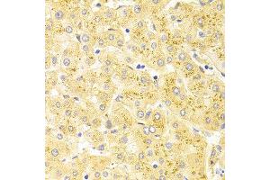 Immunohistochemistry of paraffin-embedded human liver injury using WT1 antibody at dilution of 1:100 (x400 lens). (WT1 抗体)