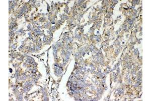 IHC testing of FFPE human lung cancer tissue with TSPAN12 antibody at 1ug/ml.
