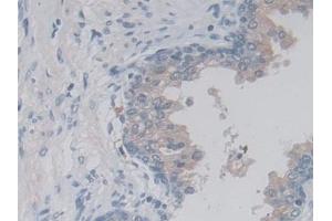 Detection of LACTb in Human Prostate Tissue using Polyclonal Antibody to Lactamase Beta (LACTb) (LACTB 抗体  (AA 313-547))