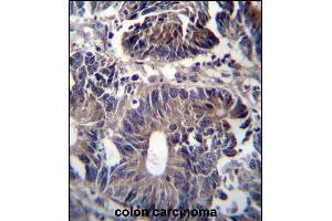 ZFYVE19 Antibody (C-term) (ABIN656951 and ABIN2846138) immunohistochemistry analysis in formalin fixed and paraffin embedded human colon carcinoma followed by peroxidase conjugation of the secondary antibody and DAB staining. (ZFYVE19 抗体  (C-Term))