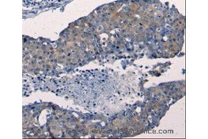 Immunohistochemistry of Human breast cancer using FGF2 Polyclonal Antibody at dilution of 1:50 (FGF2 抗体)