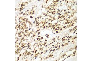 Immunohistochemistry of paraffin-embedded human kidney cancer using SMAD9 antibody (ABIN5975592) at dilution of 1/100 (40x lens). (SMAD9 抗体)