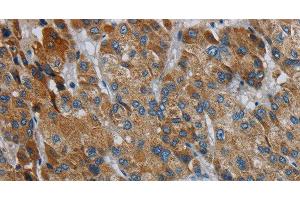 Immunohistochemistry of paraffin-embedded Human liver cancer using PDSS2 Polyclonal Antibody at dilution of 1:30 (PDSS2 抗体)
