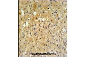 P450R Antibody (Center) (ABIN390416 and ABIN2840804) IHC analysis in formalin fixed and paraffin embedded human hepatocarcinoma tissue followed by peroxidase conjugation of the secondary antibody and DAB staining. (POR 抗体  (AA 462-488))