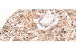Immunohistochemistry of paraffin-embedded Human esophagus cancer tissue using KNOP1 Polyclonal Antibody at dilution of 1:85(x200) (KNOP1 抗体)