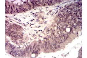Immunohistochemical analysis of paraffin-embedded esophageal cancer tissues using HTRA2 mouse mAb with DAB staining. (HTRA2 抗体  (AA 278-458))