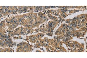 Immunohistochemistry of paraffin-embedded Human breast cancer tissue using TBXAS1 Polyclonal Antibody at dilution 1:30 (TBXAS1 抗体)