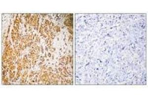 Immunohistochemistry analysis of paraffin-embedded human breast carcinoma tissue, using ZSCAN22 antibody.