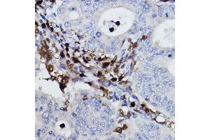 Immunohistochemistry of paraffin-embedded human colon carcinoma using NCF4/p40-phox Rabbit mAb (ABIN7268900) at dilution of 1:100 (40x lens).