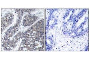 Immunohistochemical analysis of paraffin-embedded human breast carcinoma tissue, using Pyk2 (Ab-402) antibody (E021209). (PTK2B 抗体)