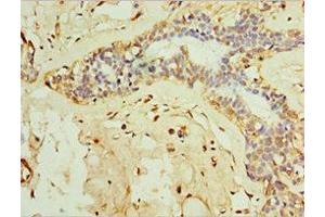 Immunohistochemistry of paraffin-embedded human breast cancer using ABIN7156612 at dilution of 1:100 (IL28B 抗体  (AA 22-196))