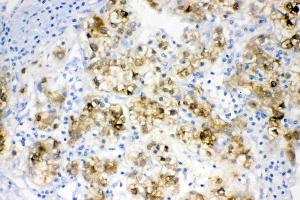IHC analysis of ADH1A using anti- ADH1A antibody . (ADH1A 抗体  (AA 213-375))