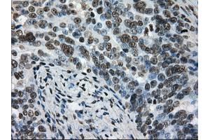 Immunohistochemical staining of paraffin-embedded Adenocarcinoma of colon tissue using anti-L1CAMmouse monoclonal antibody. (L1CAM 抗体)