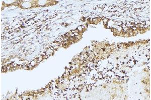 ABIN6275349 at 1/100 staining Human lung cancer tissue by IHC-P. (PEX14 抗体  (Internal Region))