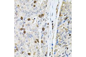 Immunohistochemistry of paraffin-embedded human prostate cancer using PNKP antibody (ABIN2564598) at dilution of 1:100 (40x lens). (PNKP 抗体)