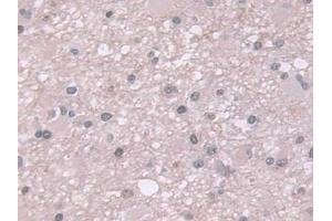 Detection of Ub in Human Glioma Tissue using Polyclonal Antibody to Ubiquitin (Ub)