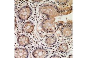 Immunohistochemical analysis of STEAP2 staining in human colon cancer formalin fixed paraffin embedded tissue section. (STEAP2 抗体  (C-Term))