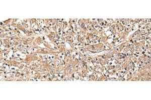Immunohistochemistry of paraffin-embedded Human liver cancer tissue using LEPR Polyclonal Antibody at dilution of 1:30(x200) (Leptin Receptor 抗体)