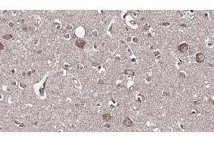 ABIN6277595 at 1/100 staining Human brain cancer tissue by IHC-P. (GDI1 抗体  (Internal Region))