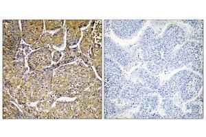 Immunohistochemistry analysis of paraffin-embedded human liver carcinoma tissue, using CYP8B1 antibody. (CYP8B1 抗体  (Internal Region))
