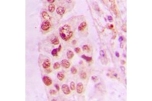 Immunohistochemical analysis of LIMK2 staining in human lung cancer formalin fixed paraffin embedded tissue section. (LIMK2 抗体  (Center))