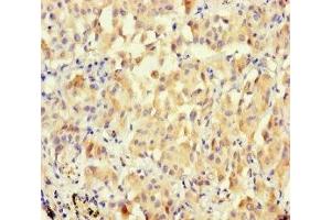 Immunohistochemistry of paraffin-embedded human lung cancer using ABIN7166679 at dilution of 1:100 (BPESC1 抗体  (AA 1-116))