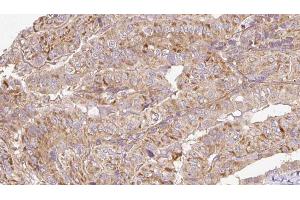 ABIN6273304 at 1/100 staining Human thyroid cancer tissue by IHC-P. (RAB14 抗体  (C-Term))
