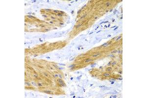 Immunohistochemistry of paraffin-embedded human gastric cancer using HRas antibody at dilution of 1:100 (40x lens). (HRAS 抗体)