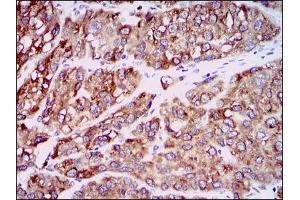 Immunohistochemical analysis of paraffin-embedded liver cancer tissues using CCL2 mouse mAb with DAB staining.