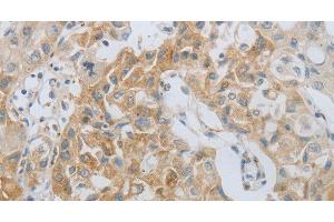 Immunohistochemistry of paraffin-embedded Human lung cancer using MMP25 Polyclonal Antibody at dilution of 1:80 (MMP25 抗体)