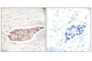 Immunohistochemical analysis of paraffin-embedded human breast carcinoma tissue using Annexin A6 antibody. (ANXA6 抗体)