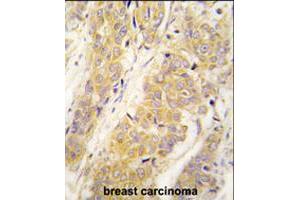 Formalin-fixed and paraffin-embedded human breast carcinoma tissue reacted with PKM2 polyclonal antibody  , which was peroxidase-conjugated to the secondary antibody, followed by DAB staining . (PKM2 抗体  (AA 483-513))