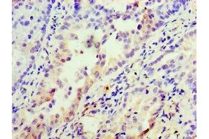 Immunohistochemistry of paraffin-embedded human lung cancer using ABIN7156235 at dilution of 1:100 (INHBA 抗体  (AA 311-426))