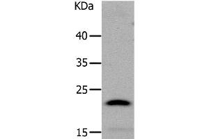 Western Blot analysis of Human liver cancer tissue using LCN2 Polyclonal Antibody at dilution of 1:1050 (Lipocalin 2 抗体)