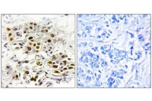 Immunohistochemistry analysis of paraffin-embedded human breast carcinoma tissue, using MAP3K6 antibody. (MAP3K6 抗体  (Internal Region))