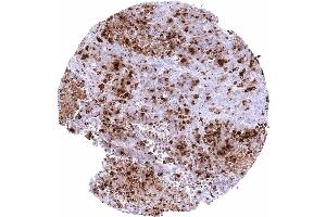 Esophagus Neuroendocrine carcinoma with strong somatostatin immunostaining of tumor cells (Recombinant Somatostatin 抗体)