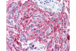 Anti-MRGD / MRGPRD antibody IHC of human Skin, Melanoma. (MRGPRD 抗体  (Extracellular Domain))