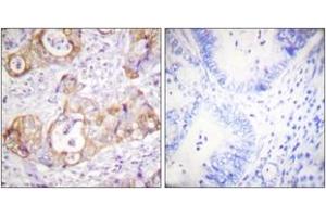 Immunohistochemistry analysis of paraffin-embedded human colon carcinoma, using Keratin 8 (Phospho-Ser432) Antibody.