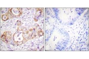 Immunohistochemistry analysis of paraffin-embedded human colon carcinoma, using Keratin 8 (Phospho-Ser432) Antibody. (KRT8 抗体  (pSer432))
