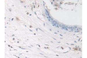 Detection of COTL1 in Human Prostate Tissue using Polyclonal Antibody to Coactosin Like Protein 1 (COTL1) (COTL1 抗体  (AA 1-142))